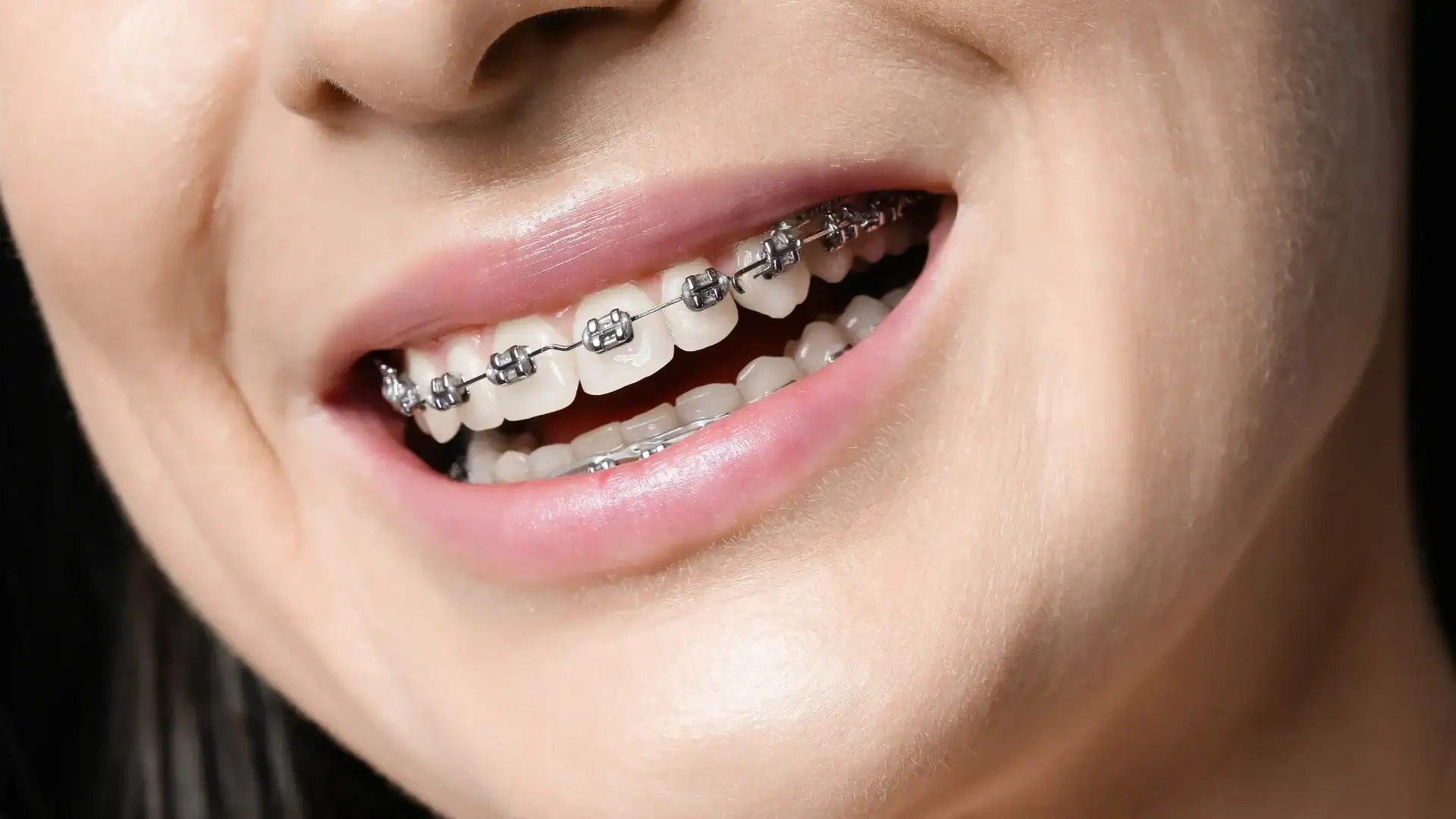 Üst dişlere yapıştırılmış metal braketler ve ark teli bulunan gülümseyen bir ağzın yakın plan görüntüsü