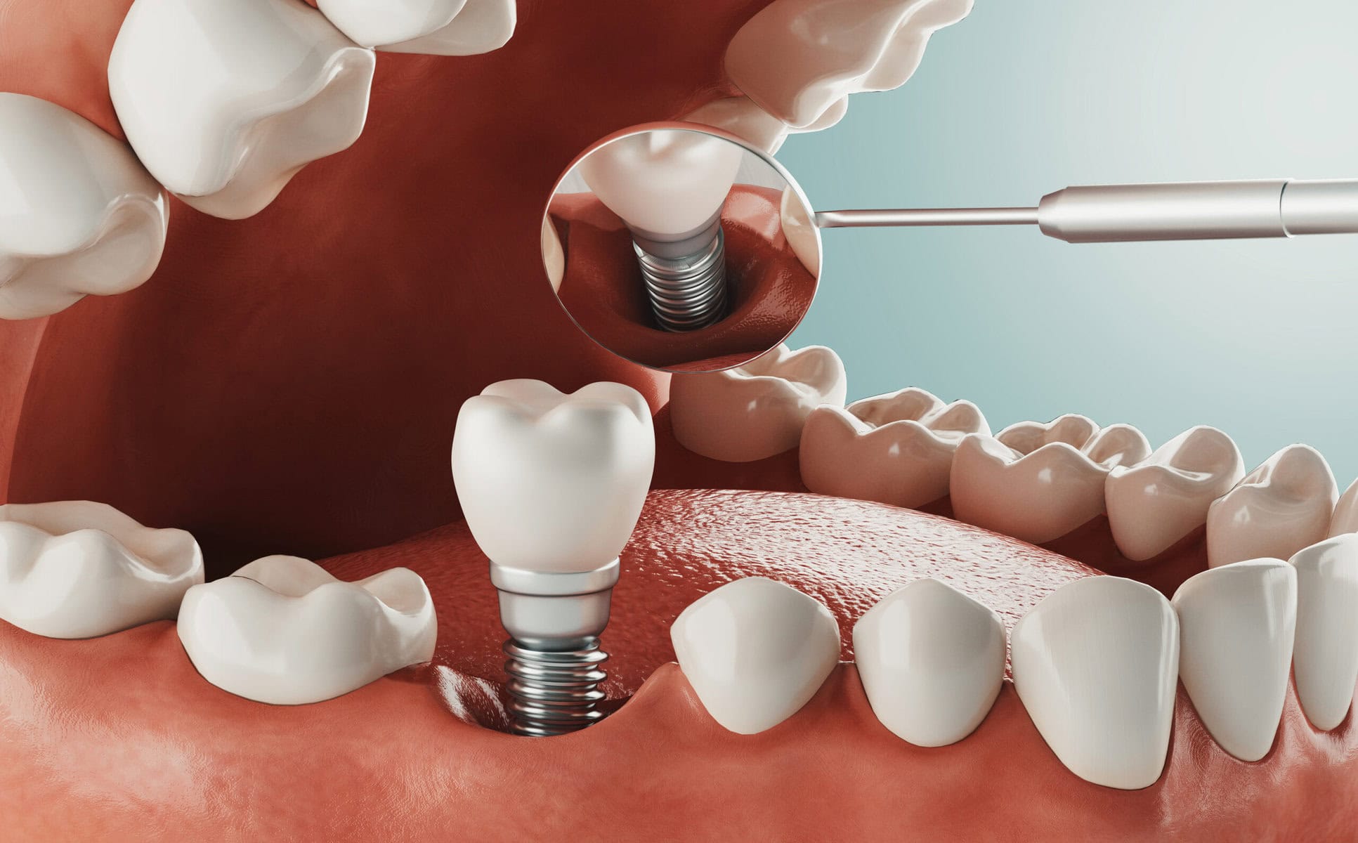 Azı dişi implant vidası ve kronu bulunan 3D alt çene görseli, aynada ikinci implant yansıması