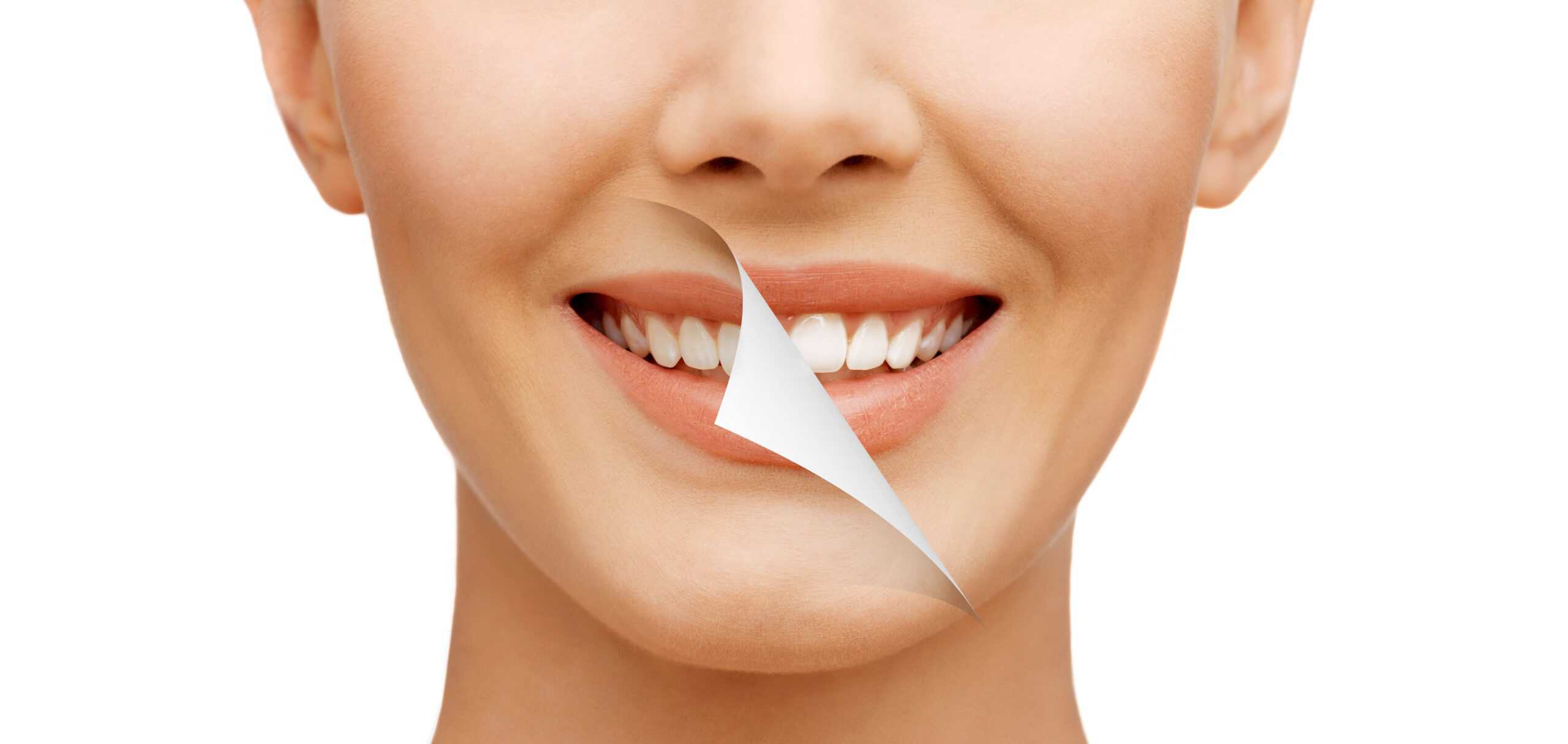 mm smile makeover