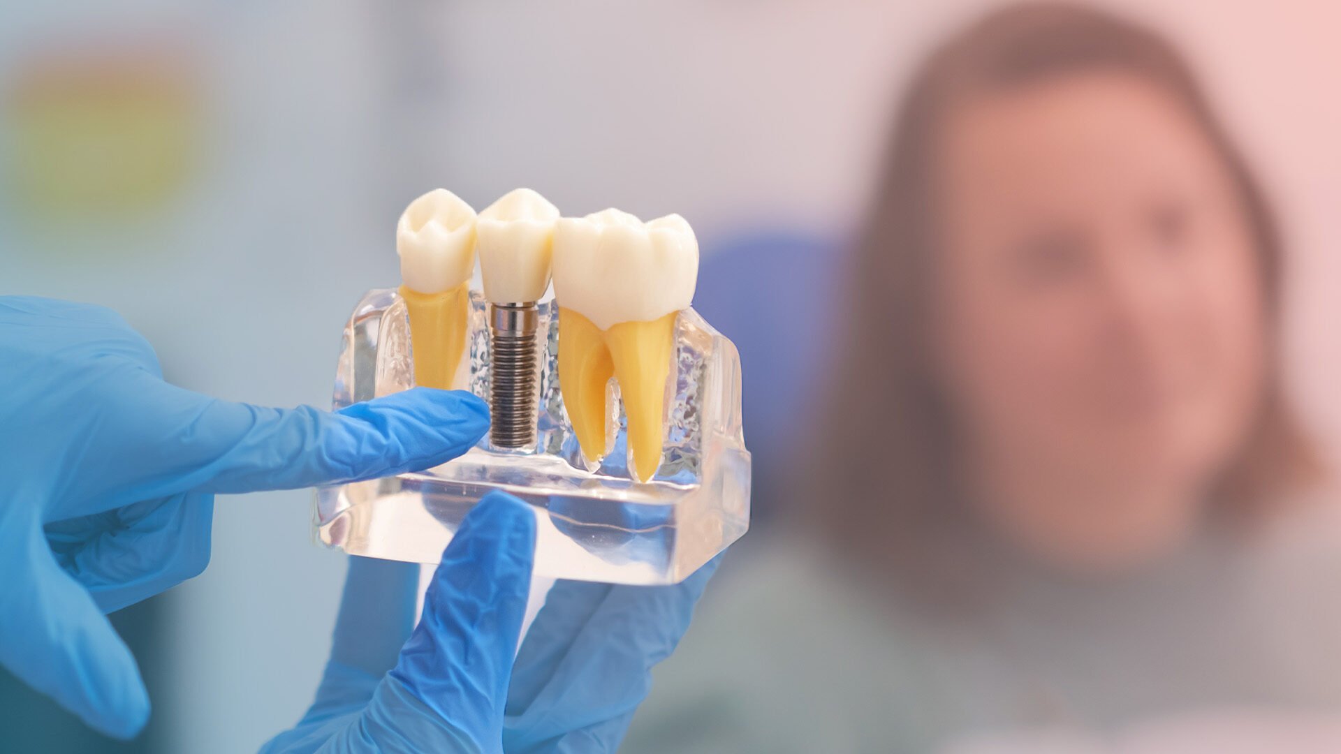 dental i̇mplants 1