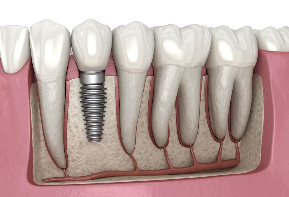 Titanyum implantın kemikle bütünleşmesi (osseointegrasyon)