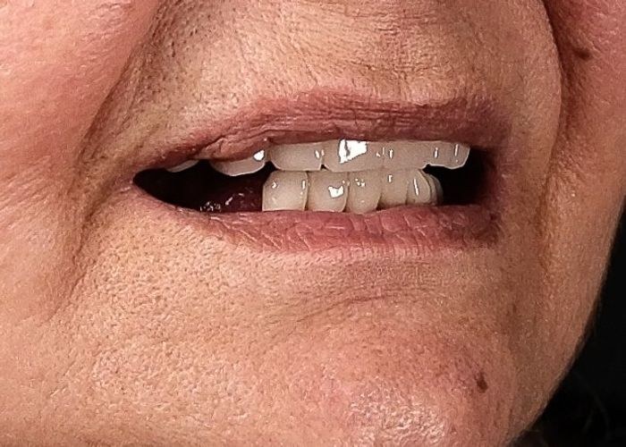 18 numaralı vaka · tedavi öncesi ağız içi yakın çekim