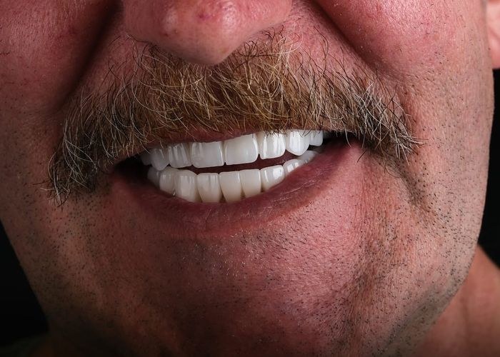 5 numaralı vaka · tedavi sonrası ağız içi yakın çekim