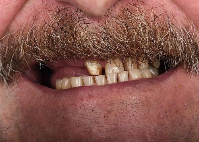 5 numaralı vaka · tedavi öncesi ağız içi yakın çekim