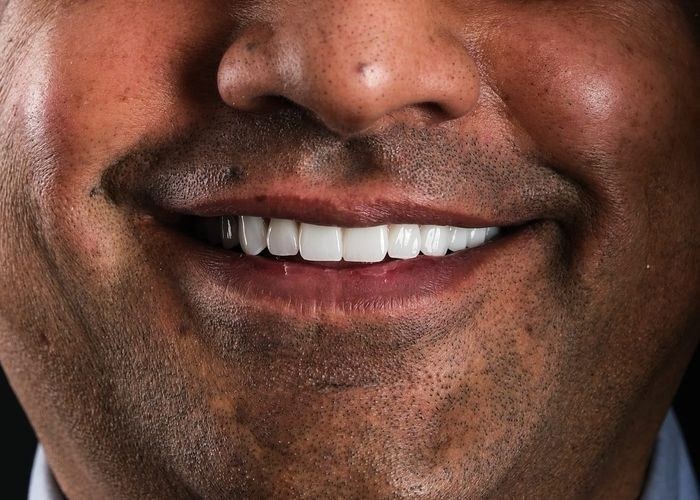 6 numaralı vaka · tedavi sonrası ağız içi yakın çekim