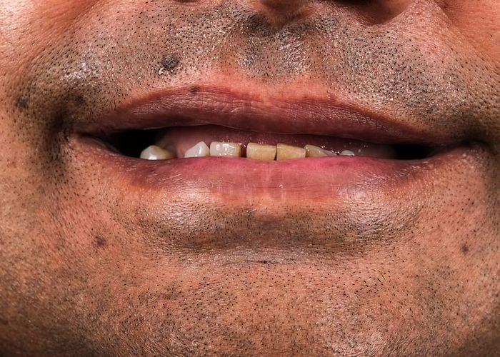 6 numaralı vaka · tedavi öncesi ağız içi yakın çekim