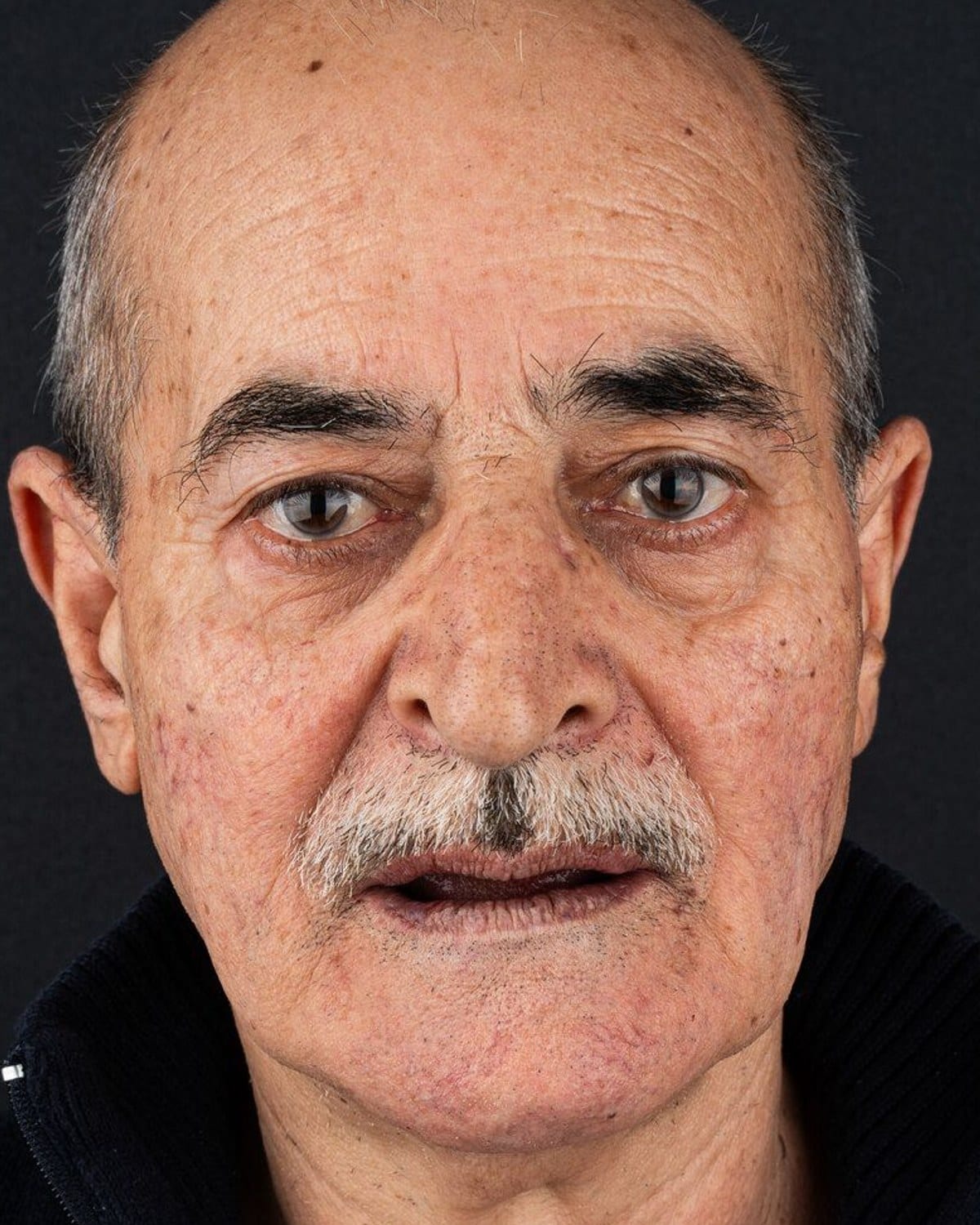 18 numaralı vaka · tedavi öncesi gülüş portresi