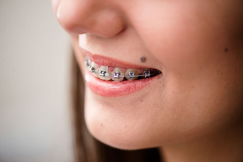 Braket