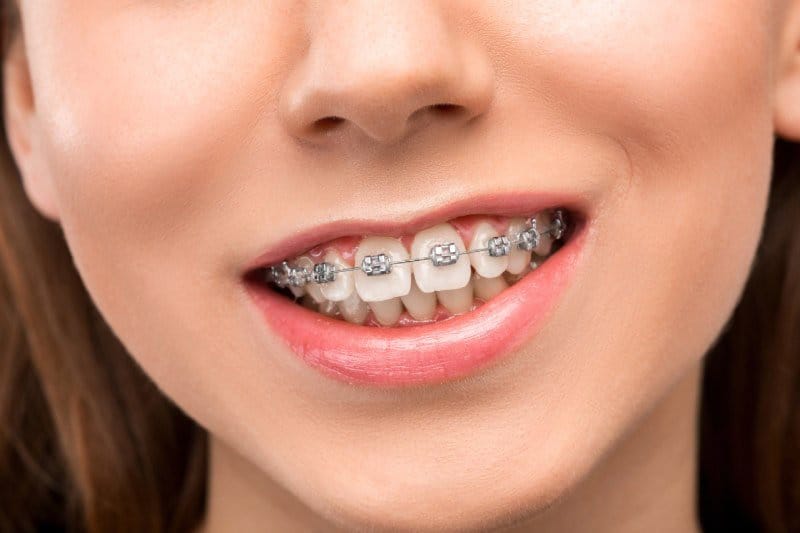 Braket Tedavisi