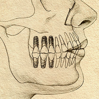 Pencil drawing of a jaw in profile with three screw-type implants and crowns in the back of both arches