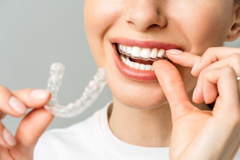 Invisalign Tedavisi