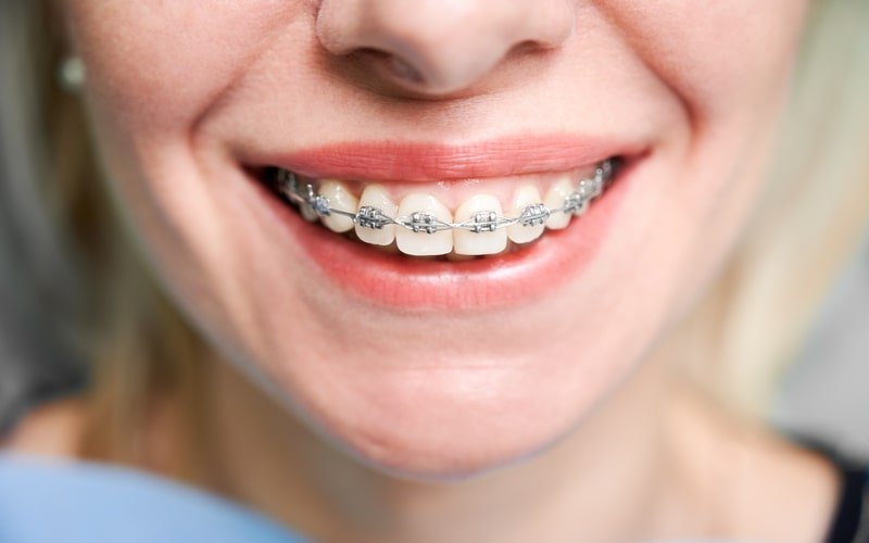 what should be considered after orthodontic treatment